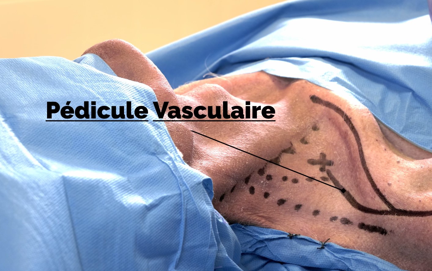 lambeaux vasculaires